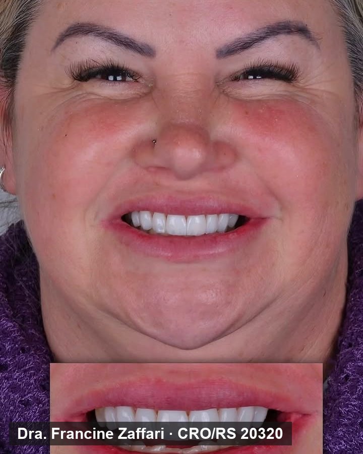 Paciente sorrindo depois do tratamento, com detalhe dos dentes