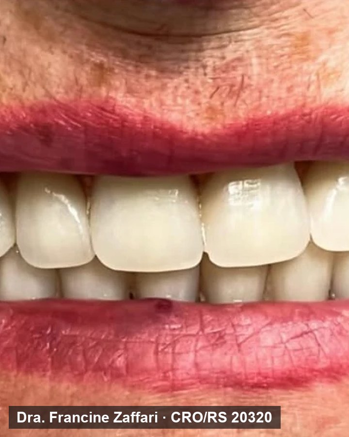 Detalhe do sorriso de paciente depois do tratamento