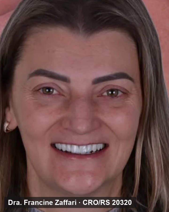 Paciente sorrindo depois do tratamento, em parceria com Dr. Andrei Rafagnin